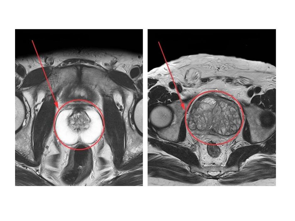 Параўнанне здаровай (злева) і запалёнай (справа) прастаты на МРТ-здымках